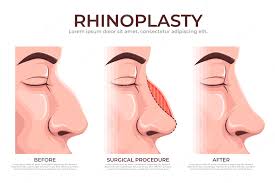 Rhinoplasty Surgery In Iran